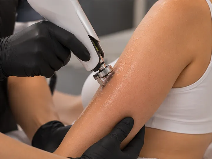 Mesotherapie am Oberarm